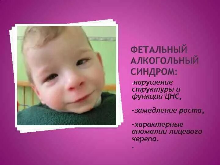 Синдром алкогольного ребенка. Фетальный алкогольный синдром. алкогольный синдром плода. алкогольный синдром у детей. фетальный алкогольный синдром у детей.