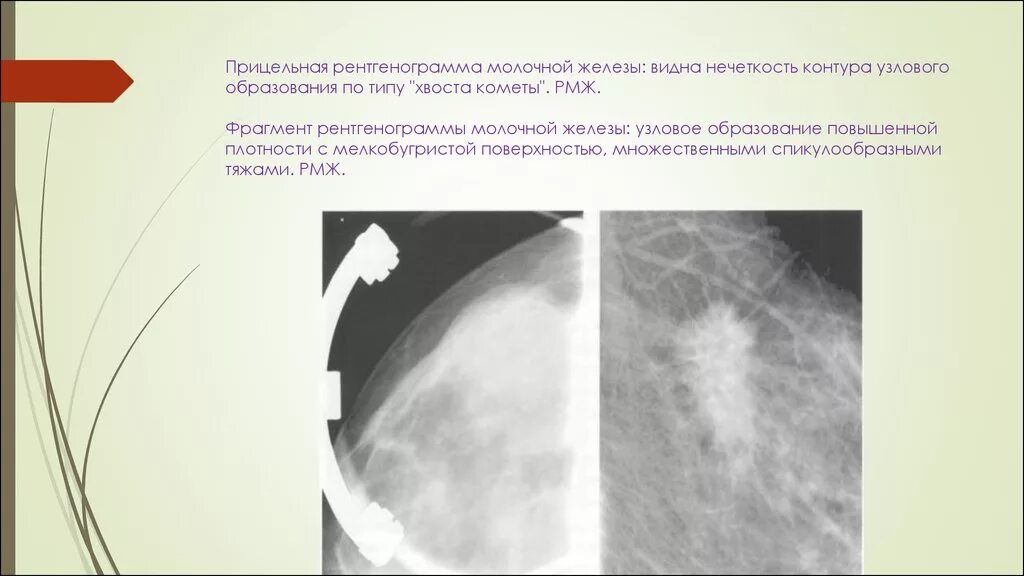 Кистозная мастопатия маммография. Фиброаденома молочной железы маммография. Саркома молочной железы на рентгенограмме. Узловая мастопатия на маммографии. Признаки фиброзных изменений молочных желез