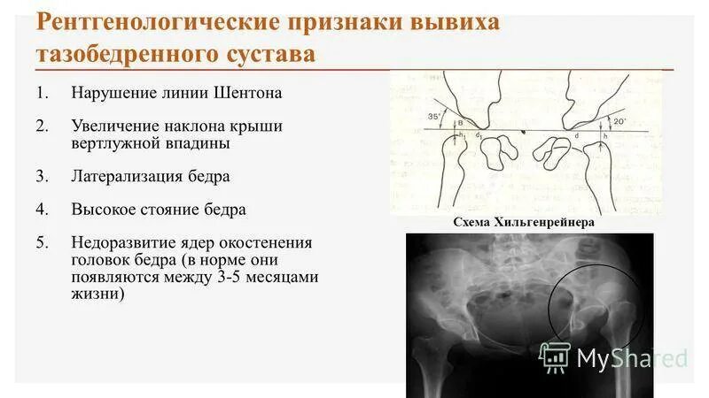 Травматические вывихи бедра: классификация. Подвывих тазобедренного сустава кла. Вывих головки бедренной кости рентген. Растяжение связок тазобедренного сустава. Вывих тазобедренного сустава у взрослых.