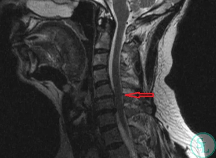 Грыжа шейного отдела позвоночника с5-с6. Секвестрированная грыжа мрт. Грыжа шейного отдела позвоночника мрт. Секвестрированная грыжа шейного отдела с5-с6. Начальное дегенеративные изменения шейного отдела