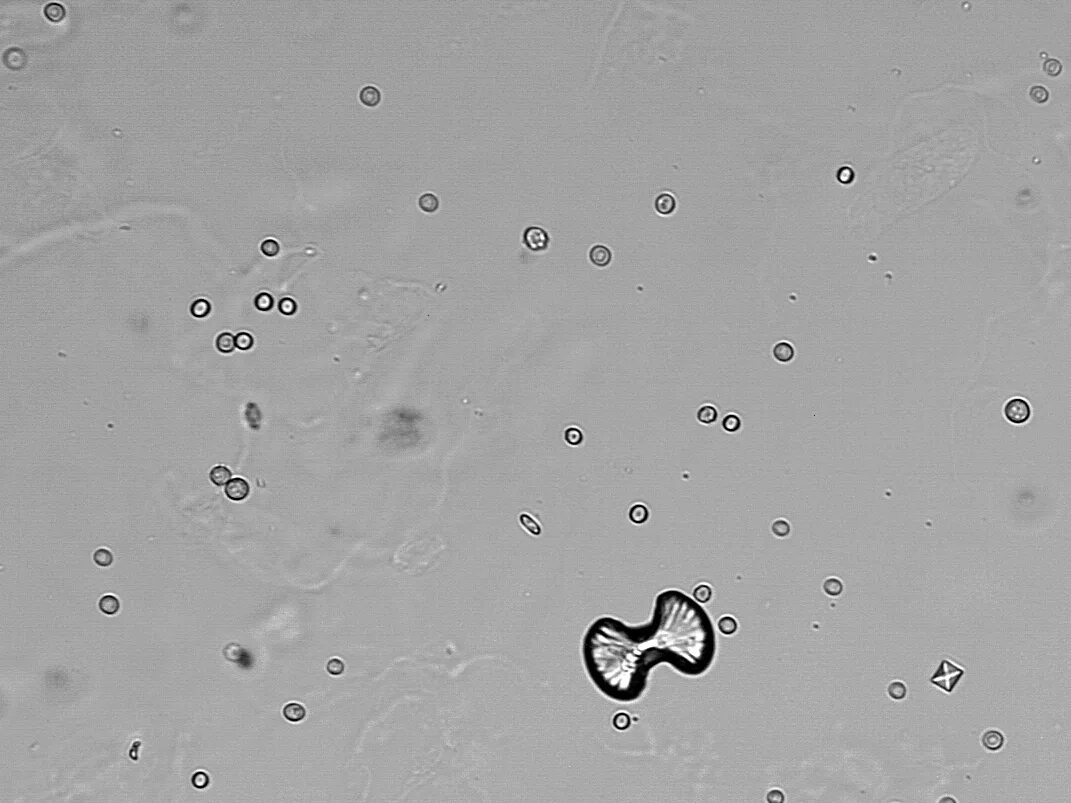 Кристаллы оксалата кальция микроскопия. Оксалаты кальция в моче. Оксалаты микроскопия мочи. Оксалаты кальция микроскопия. Кристаллы кальция в моче у мужчин