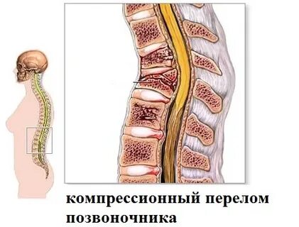 Компрессионный перелом th12