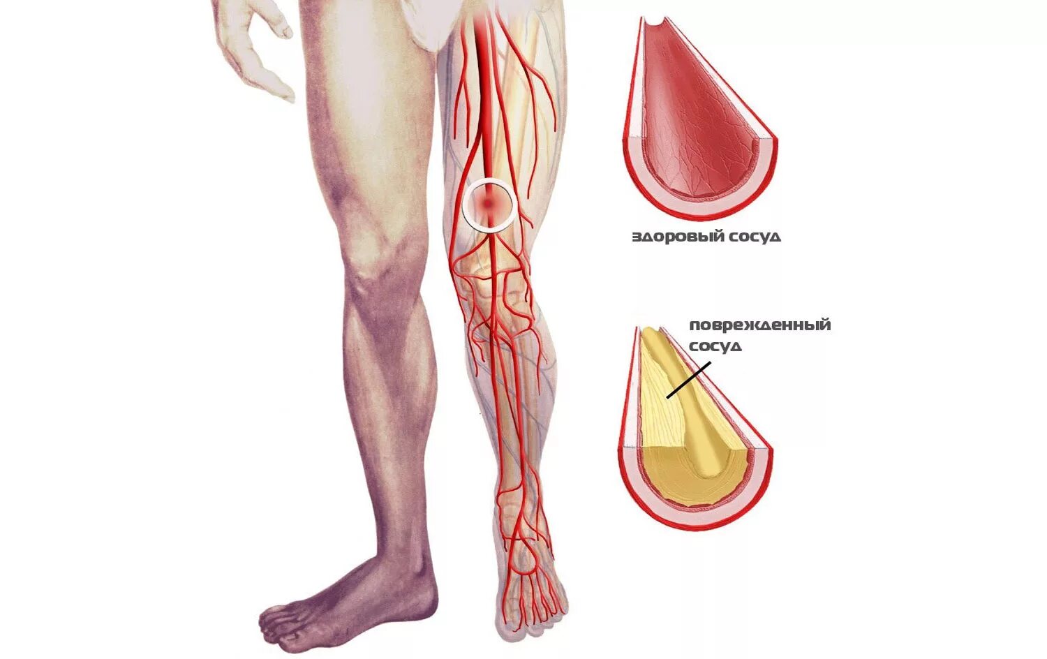 Атеросклеротическое поражение нижних конечностей