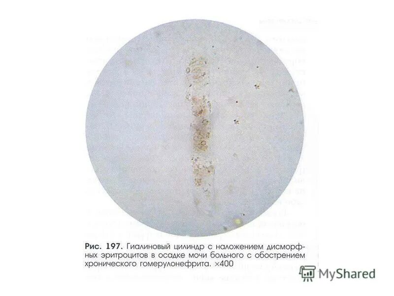 Дрожжевые грибы в моче. Слизь эритроциты. Слизь эритроциты. Нормальные показатели оам у мужчин. Лейкоциты в желчи микроскопия.