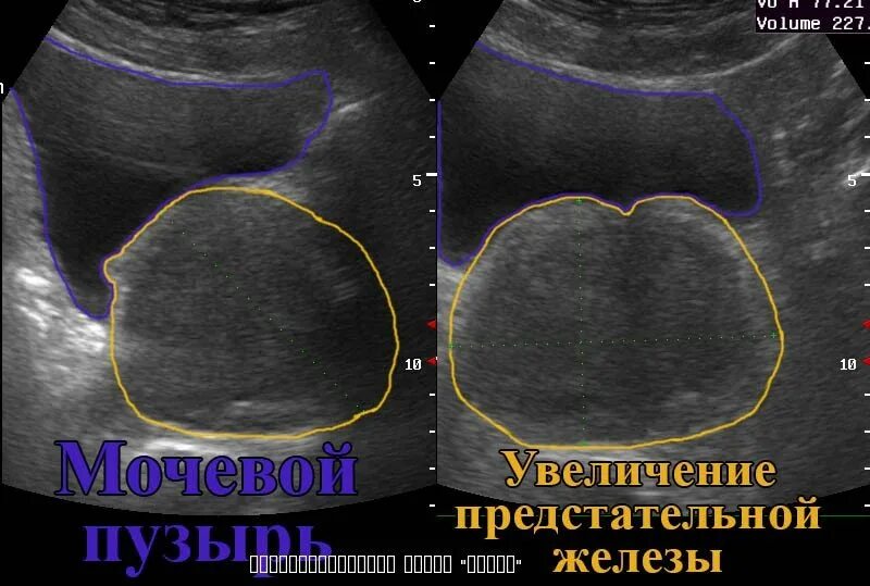 Дгпж узи. Аденома предстательной железы на УЗИ. УЗИ предстательной железы трансабдоминально. УЗИ доброкачественная гиперплазия предстательной железы. УЗИ предстальнойжелезы.