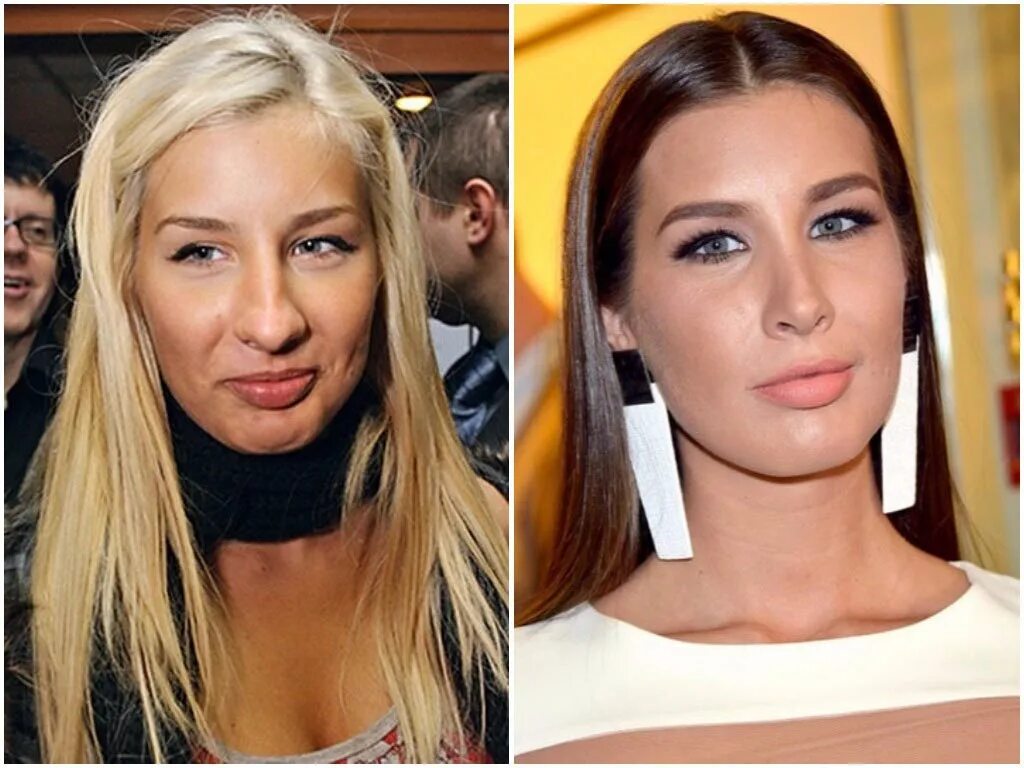 Какую пластическую операцию делала