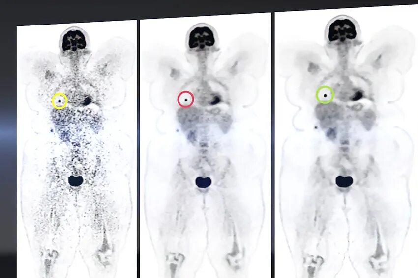 Позитронно-эмиссионная томография кт. Позитрон-эмиссионная  томография: ПЭТ. Как пройти пэт кт