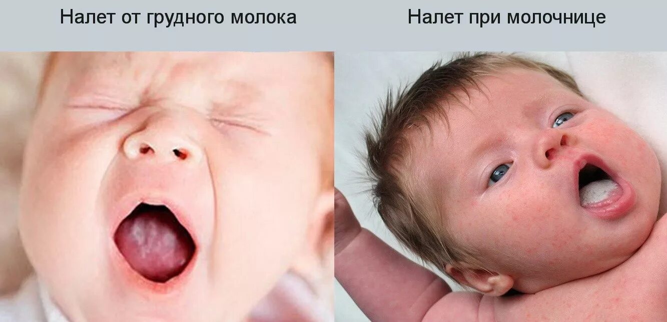 Кандид во рту у новорожденного. Полость рта новорожденного. Кандидозный стоматит у новорожденных. Молочница во рту у грудничка. Молочница на груди при гв.