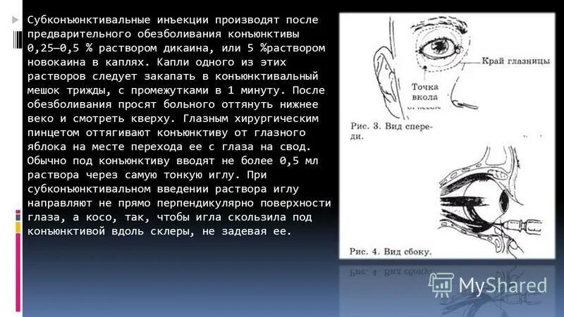 Субтеноновое пространство глаза. Презентация по биологии глаз. Субконъюнктивальное введение. Вводить субконъюнктивально и в переднюю камеру глаза. Закладывание глазной мази за нижнее веко.