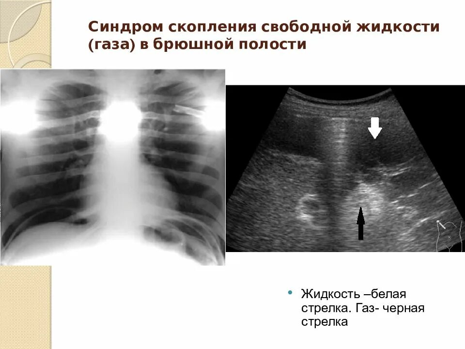 Почему после операции скапливается жидкость. Почему после операции скапливается жидкость