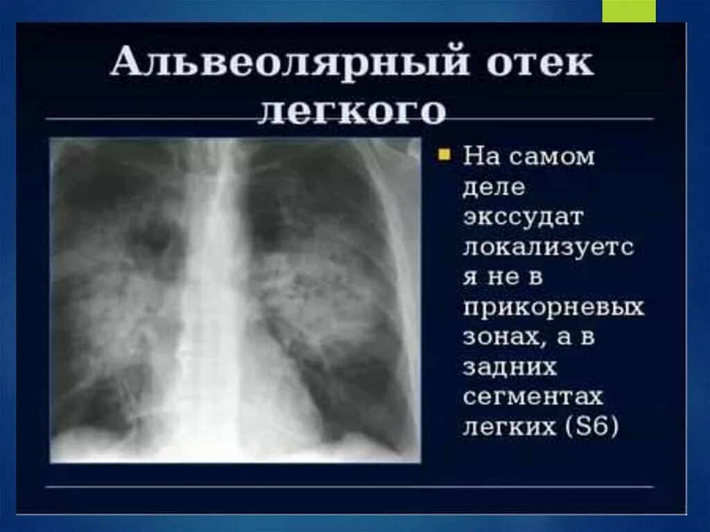 Отек легких симптомы у взрослых. Альвеолярный отек легких. аоюальвеолярный отке легких. альвеолярный отёк лёгких.