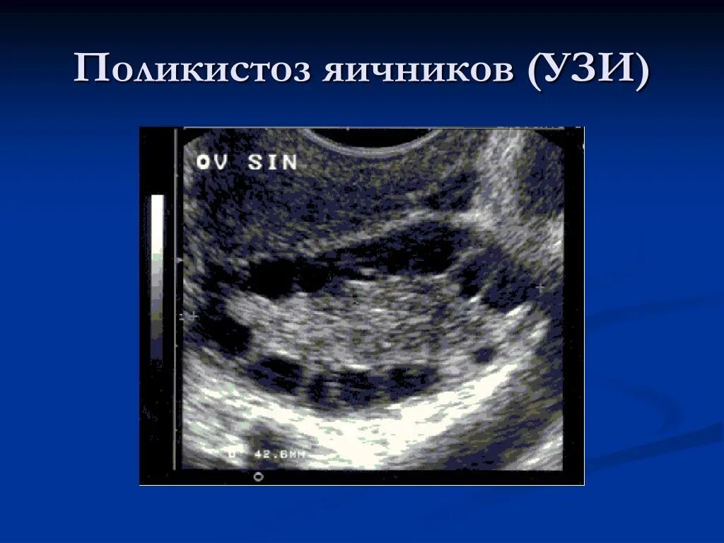 УЗИ признаки поликистоза яичников. Синдром поликистоза яичников на УЗИ. Снимок УЗИ поликистоз яичников.