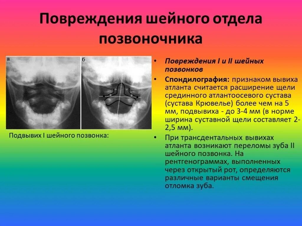 Подвывих по ковачу. Подвывих с1 позвонка рентген. ротационный подвывих атланта рентген. правосторонний ротационный подвывих с1.