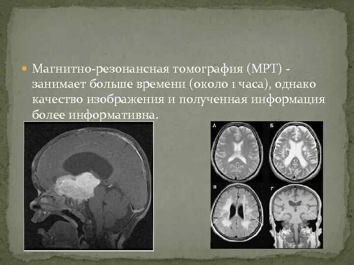 Выраженная заместительная гидроцефалия. Заместительная наружная гидроцефалия кт. Арезорбтивная гидроцефалия мрт. Наружная гидроцефалия головного мозга кт.