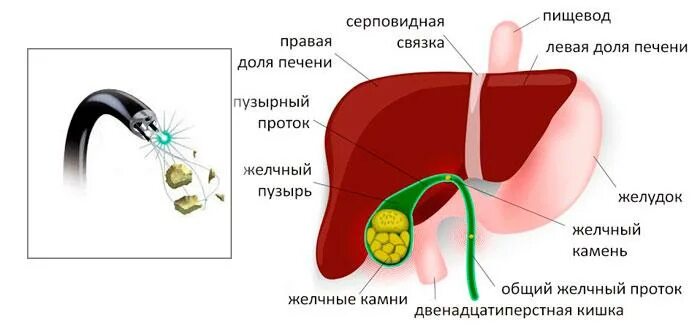 Литотрипсия желчных камней. Литотрипсия камней в желчном пузыре. ультразвуковое дробление камней в желчном пузыре. дробление камней в желчном пузыре лазером. механическая литотрипсия желчных камней.