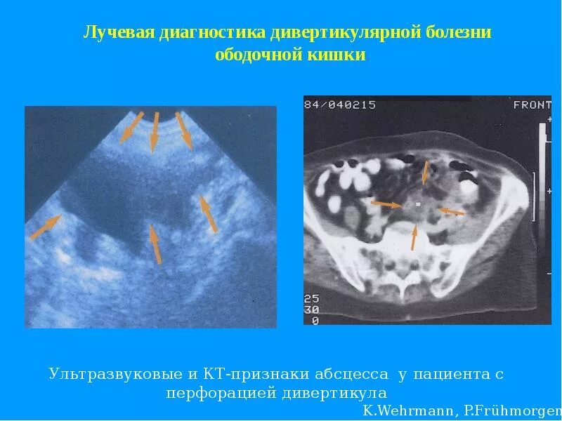 Заболевания ободочной кишки. Дивертикулярная болезнь ободочной. дивертикулит сигмовидной кишки кт. дивертикулы ободочной кишки кт. дивертикулы сигмовидной кишки на кт.