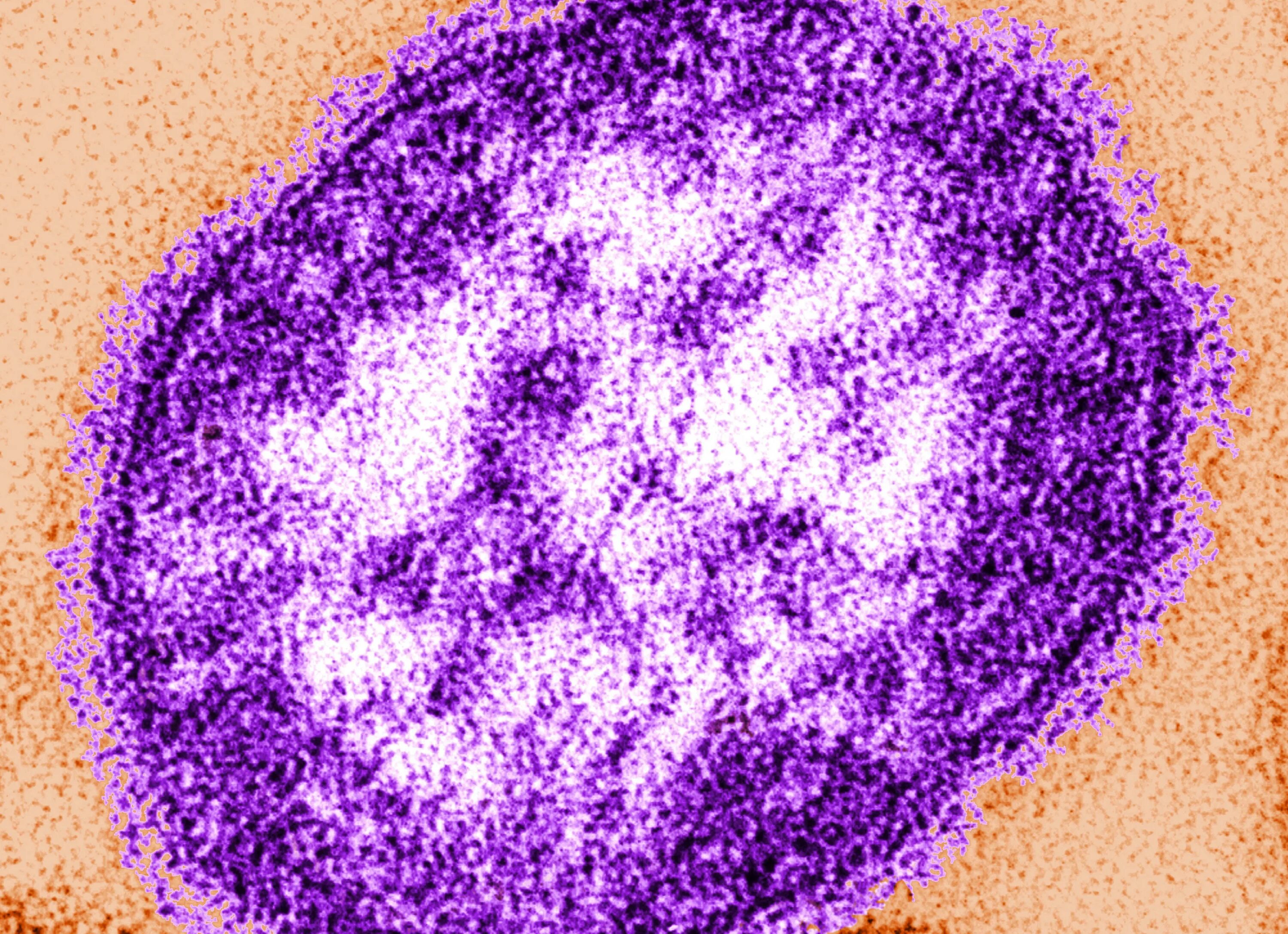 Вирус возбудителя кори. Вирус кори возбудитель. РНК-вирус рода морбилливирусов семейства парамиксовирусов. Корь под микроскопом.