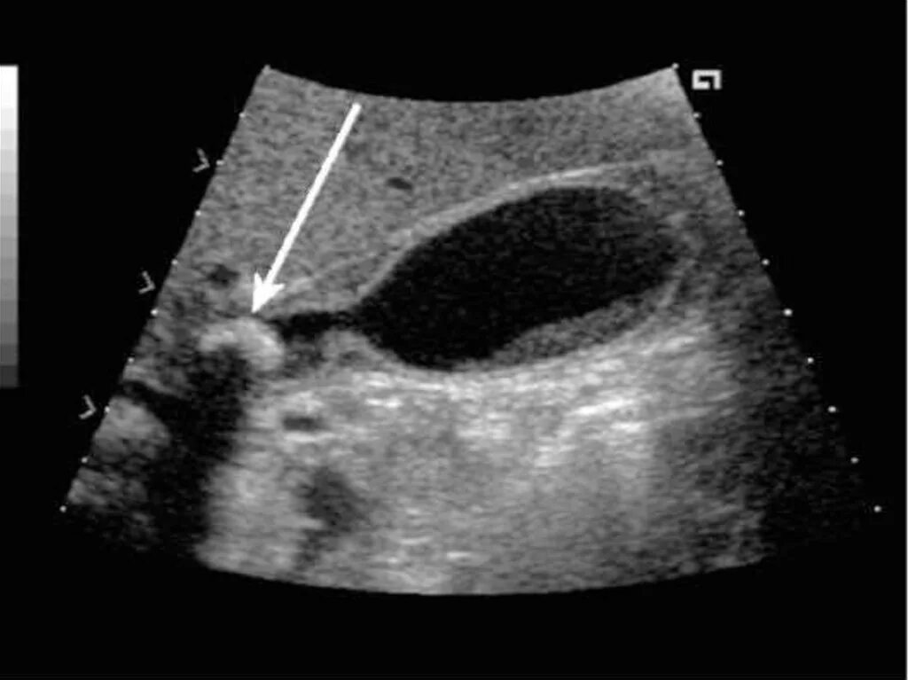 Камень в шейке желчного пузыря. УЗИ желчного пузыря желчекаменная болезнь. Конкремент в шейке желчного пузыря на УЗИ. Сонограмма желчного пузыря. Холестериновые камни в желчном на УЗИ.