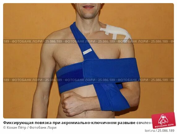 Фиксирующая повязка при ушибе. Фиксирующая повязка при ушибе. Бандаж дезо при переломе ключицы. Черепашья повязка повязка. Наложение повязки на голеностопный сустав.