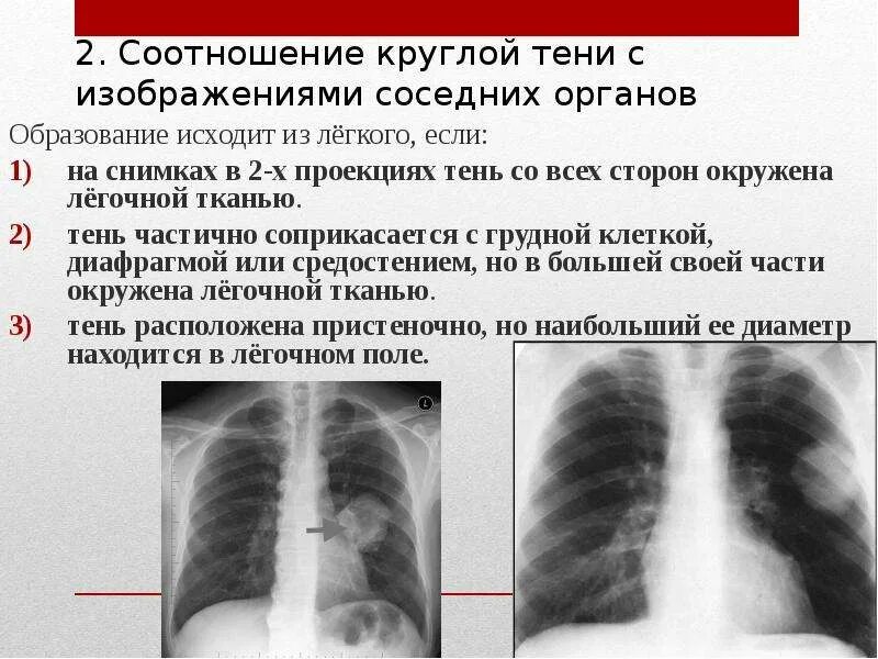 Поражение легких при ковиде. Круглая тень на рентгенограмме легких заболевания. Круглая тень в легочном поле. Округлая тень в правом легком.