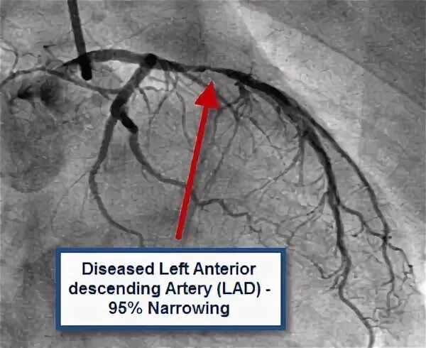 После стентирование самолет. Коронарография сосудов стентирование. Инфаркт миокарда ангиография. Стеноз коронарной артерии ангиография. Стеноз левой коронарной артерии.