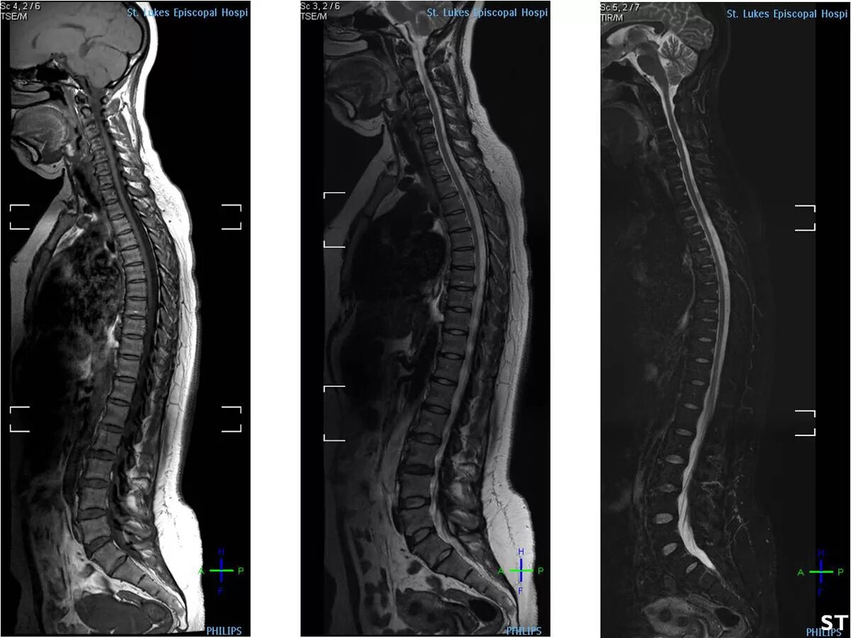 Мрт спинного отдела. Мрт грудного отдела норма. Мрт спинного мозга норма. Мрт грудного отдела позвоночника норма. Мрт сбоку здоровый позвоночник.