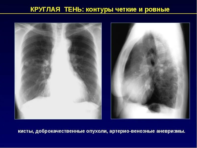 Рентгенологические синдромы легких. Круглые тени на рентгене легких. Синдром круглой тени на рентгенограмме легких. Округлая тень на рентгене легких.