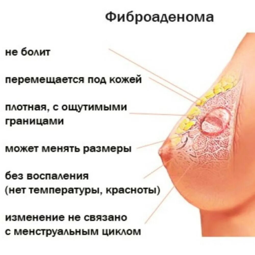 Фиброма в груди. Фиброаденома молочной железы симптомы. Молочные железы фибдаринома. Уплотнение в грудной железе. Уплотнение в молочной железе болит.