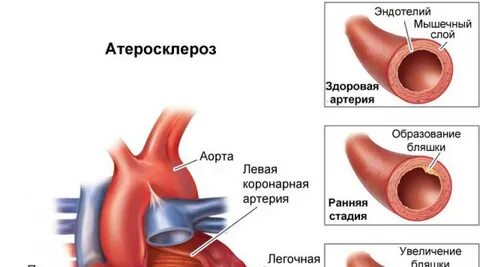 Внезапная коронарная