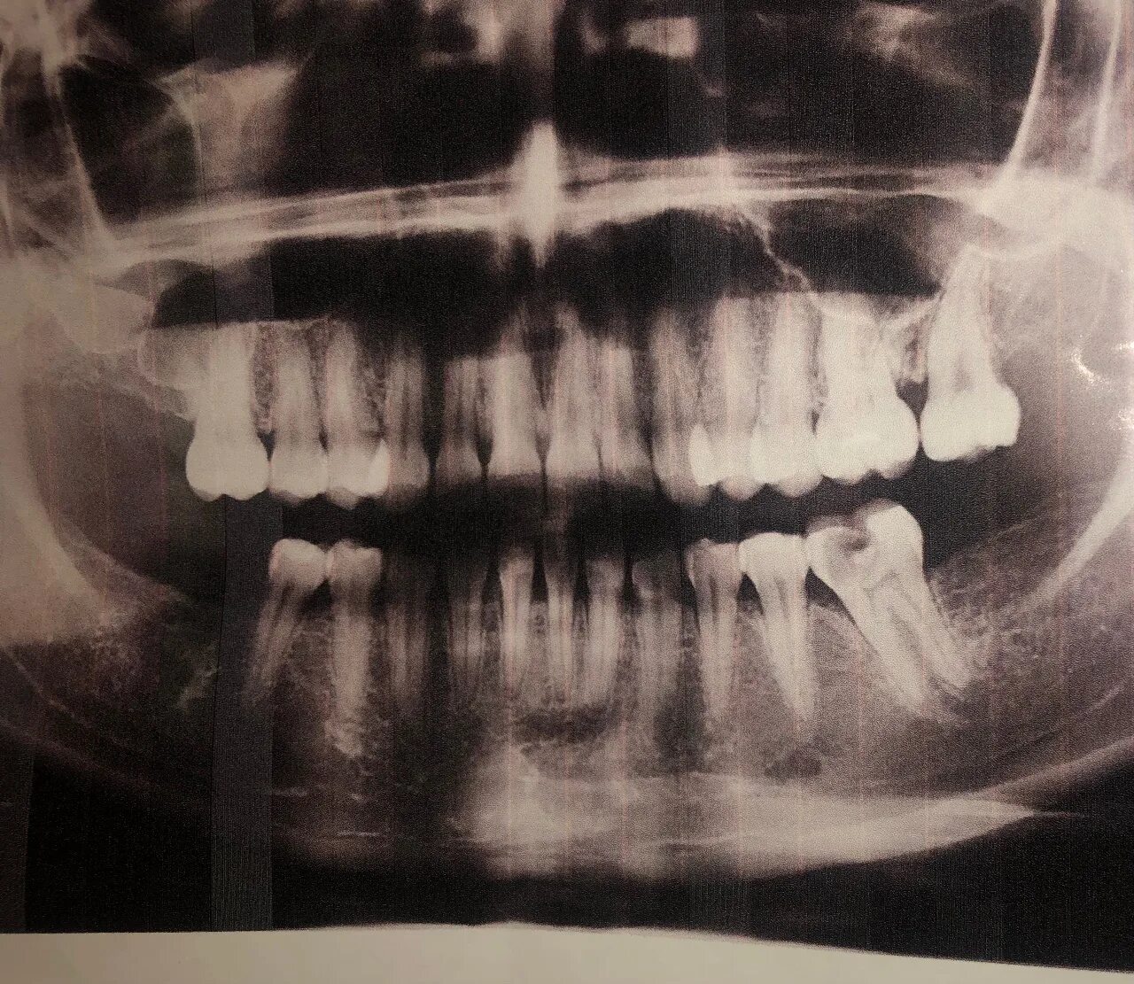 Зуб дает температуру. Корни зуба 45 попадают в пазуху. Через какой зуб очищают пазуху.