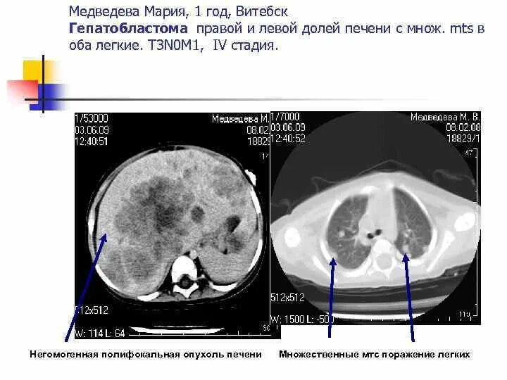 Образование в правой доле печени. Кт гепатобластома печени. Объемное образование печени на кт. Объемное образование в левой доле печени.