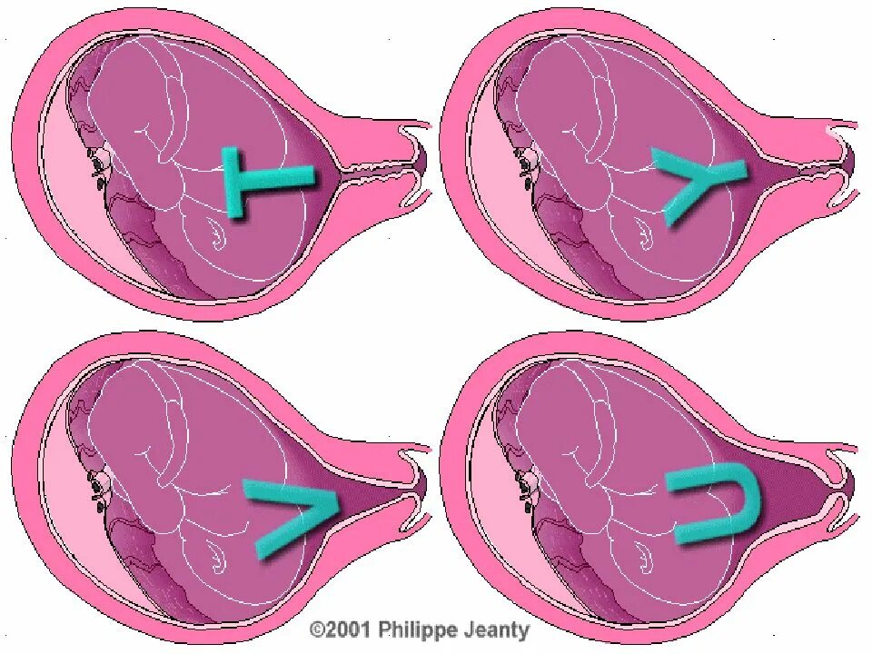 Матка 37 мм. Внутренний зев матки при беременности. Истмико-цервикальная недостаточность на УЗИ. Истмико-цервикальная недостаточность картинки. Форма внутреннего зева y-образная при беременности.