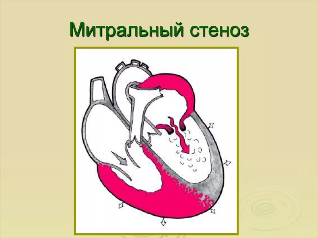 Митральный аортальный стеноз. Стеноз митрального клапана гемодинамика схема. Стеноз и недостаточность митрального клапана. Митральный стеноз гемодинамика схема. Стеноз митрального клапана гемодинамика.