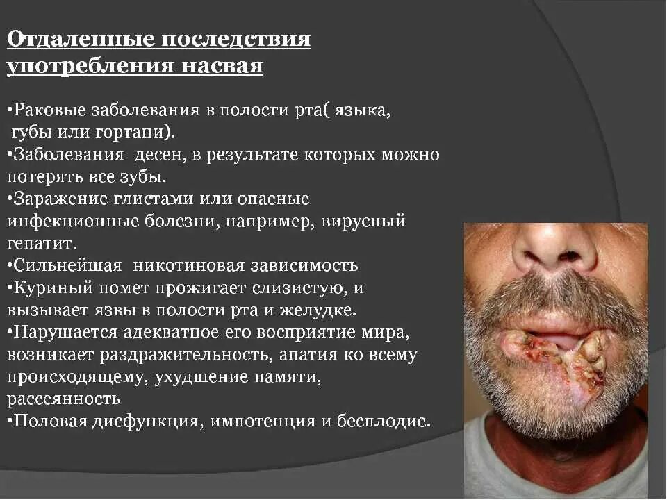 Получает болезнь. Последствия употребления насвая. Насвай последствия употребления. Последствия после насвая. Последствия употребления снюса.