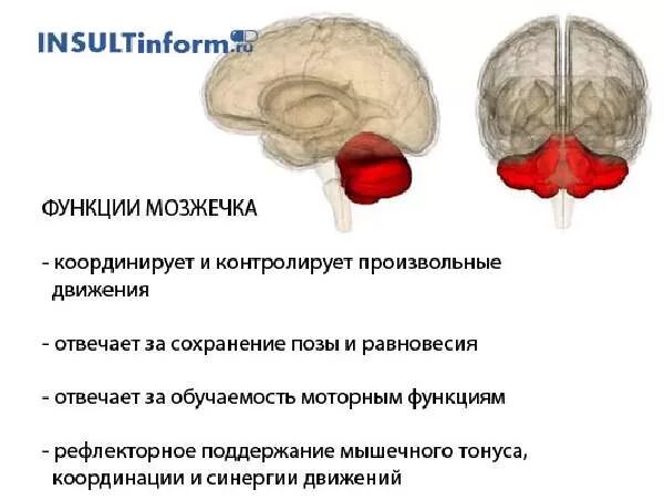 Ишемический инсульт мозжечка операция. Ишемический инсульт мозжечка последствия. Инсульт мозжечка последствия. Ишемический инсульт мозжечка , восстановление.