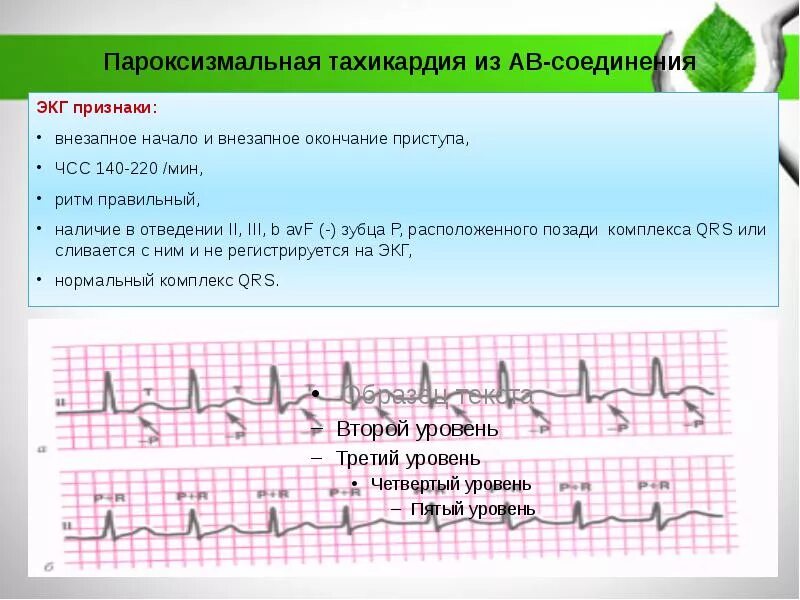 Пароксизм мерцательной аритмии ЭКГ. Синусовая Мерцательная аритмия ЭКГ. ЭКГ при пароксизмальной мерцательной аритмии. Мерцательная аритмия на ЭКГ пароксизмальная форма.