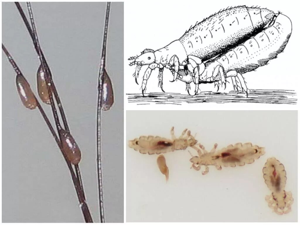Головная вошь гнида личинка. Гнида головной вши