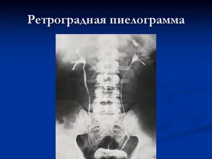 Пиелография