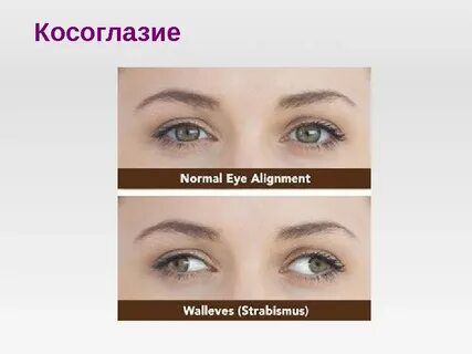 Код косоглазия