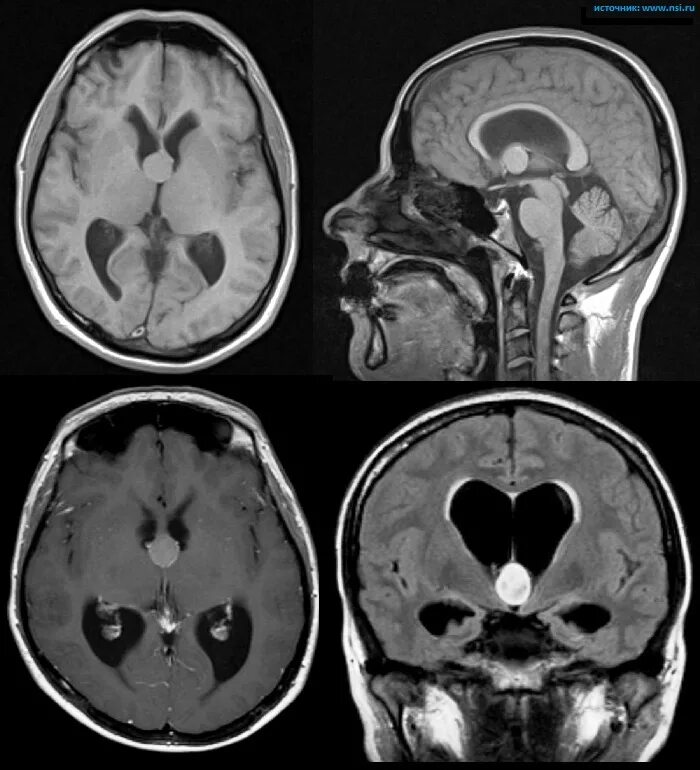 Киста головного мозга последствия. Арахноидальная киста желудочка. Арахноидальная киста 3 желудочка на кт. Киста гидроцефалия головного мозга. Киста прозрачной перегородки головного мозга на кт.
