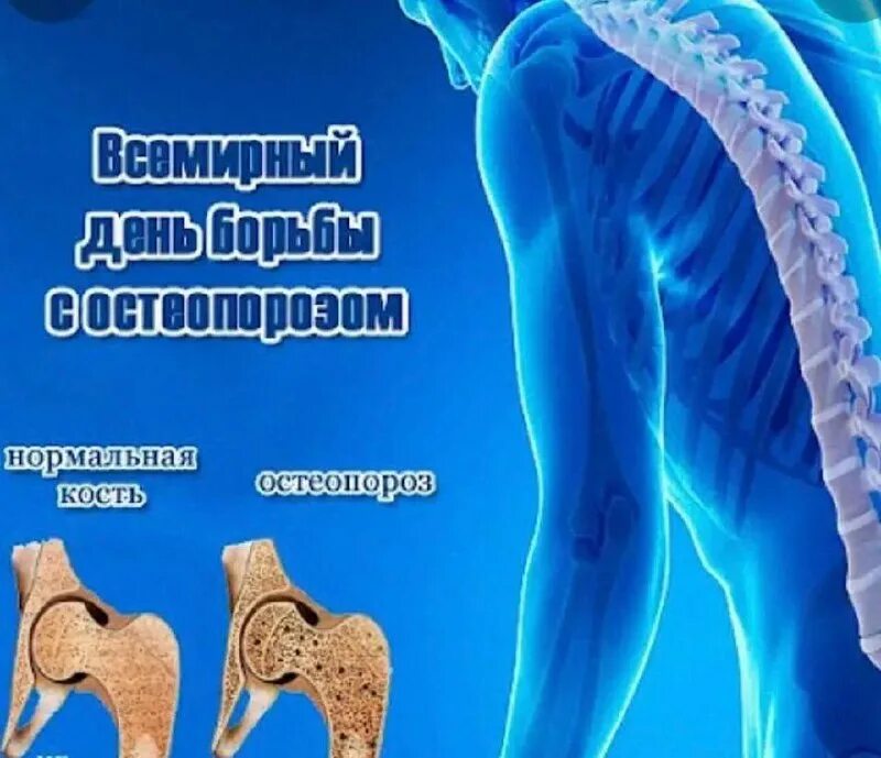 профилактика остеопороза. неделя остеопороза. анкилозирующий спондилез. остеопороз причины. акция профилактика остеопороза.