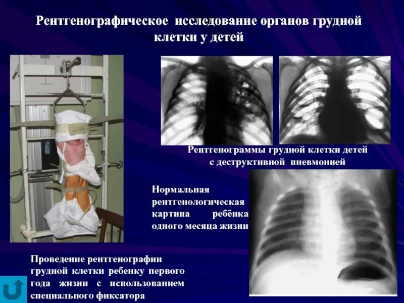 Можно делать рентген при температуре ребенку. Рентген исследование грудной клетки. рентгенология грудной клетки. рентген органов грудной клетки детям. рентгенографическое исследование органов грудной клетки.