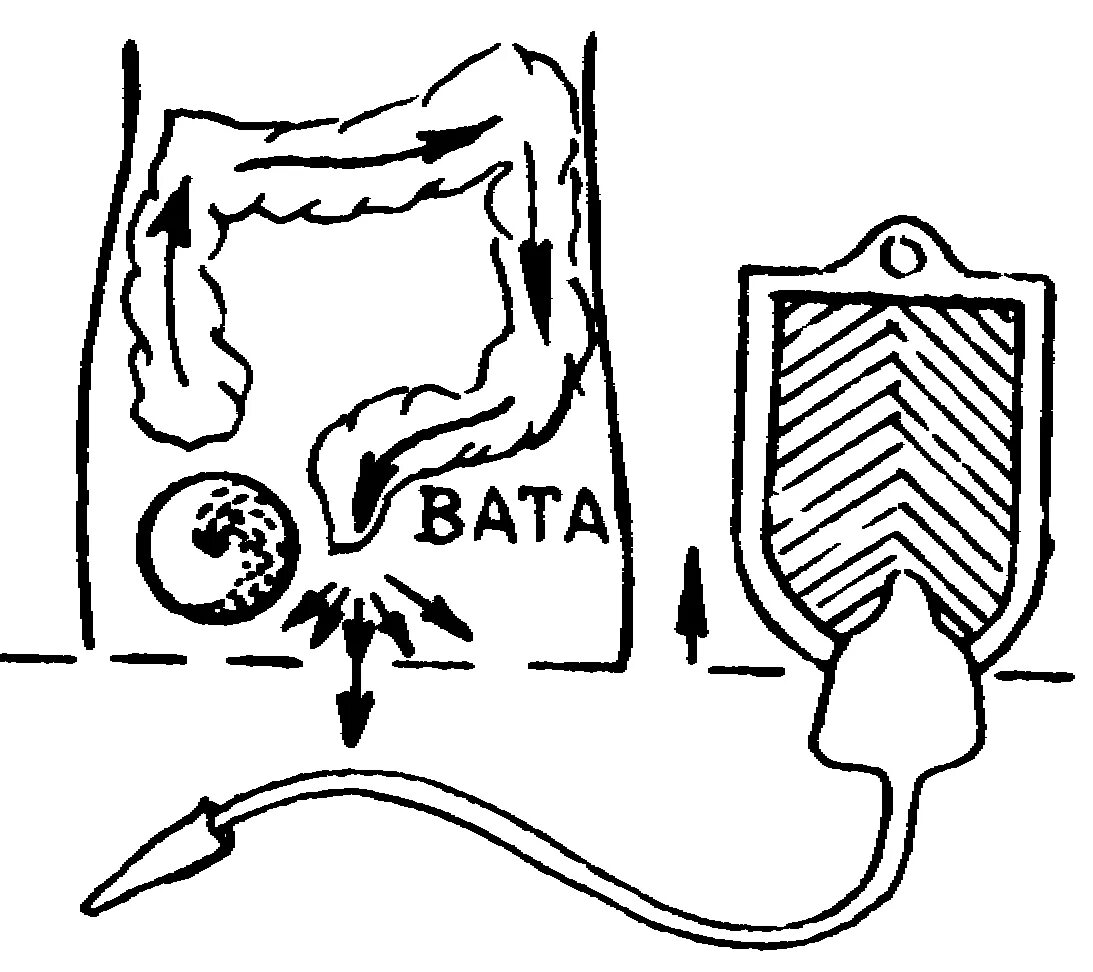 Какой бок обварили шарику. Как делать клизму схема. Очистка кишечника клизмой. Клизма для очищения кишечника. Схема очищения кишечника.