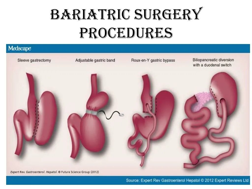 Бариатрическая хирургия. Бариатрическая операция. Что такое балеатрия.