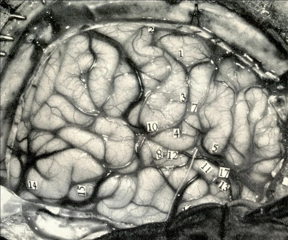 Очаги в коре головного мозга. Пенфилд мозг. Уайлдер Пенфилд мозг. Уайлдера Грейвса Пенфилда. Уайлдер Пенфилд карта мозга.