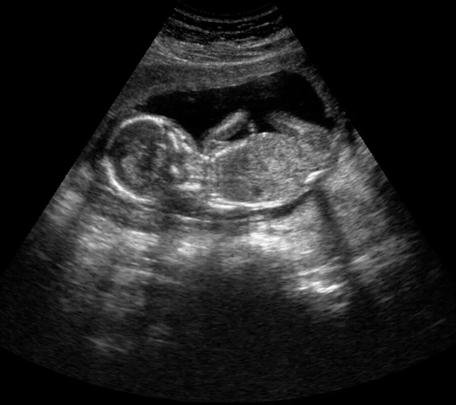 15 недель развитие. УЗИ плода на 15 неделе беременности. УЗИ 15 недель беременности пол ребенка фото. УЗИ 15 недель беременности пол. УЗИ 15 недель беременности пол ребенка девочка.