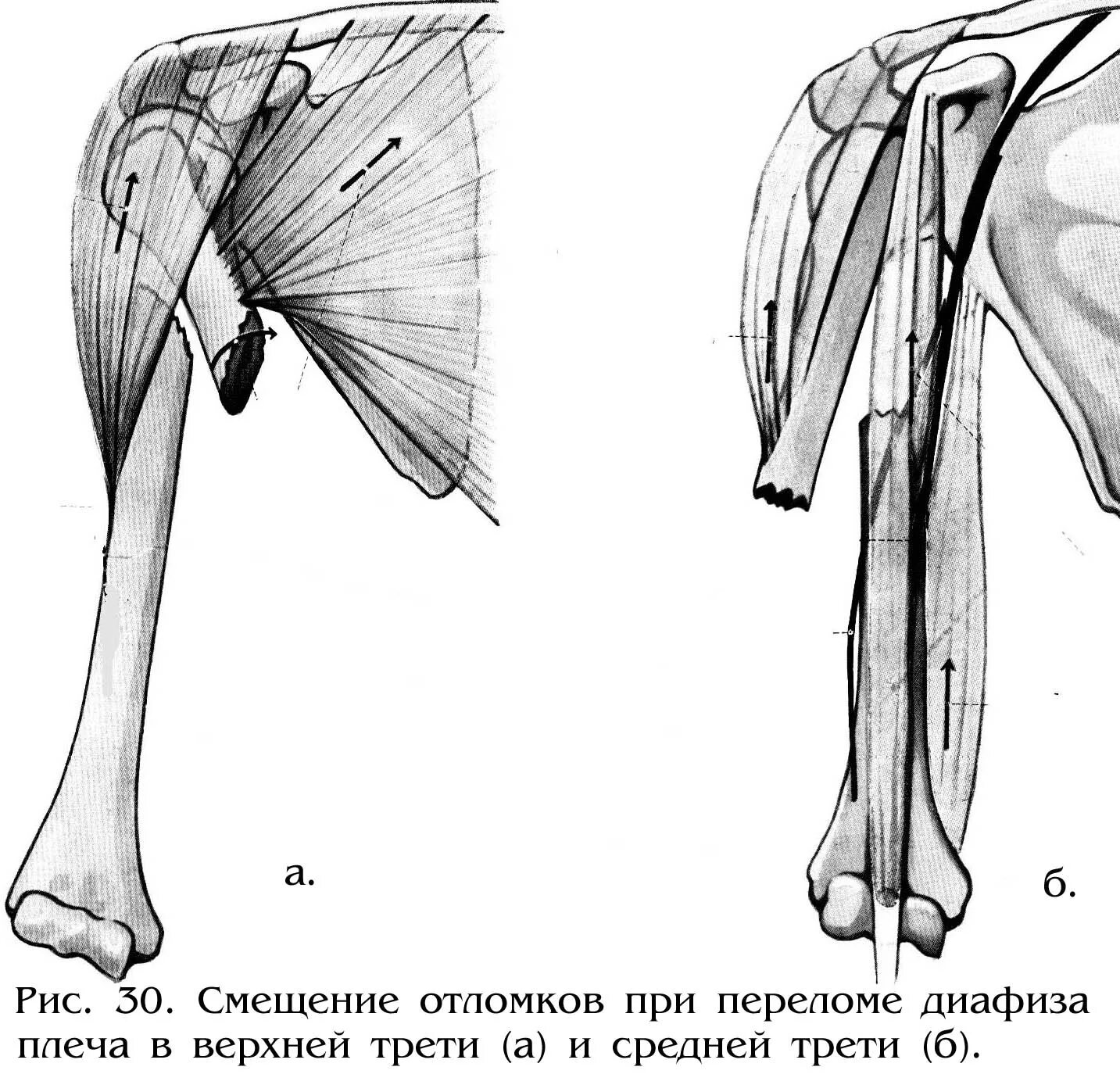 Оскольчатый перелом плеча со смещением. Перелом средней трети диафиза плечевой кости. перелом средней трети диафиза плечевой кости со смещением отломков. смещение отломков при переломе диафиза плечевой кости. перелом диафиза плечевой кости клиника.