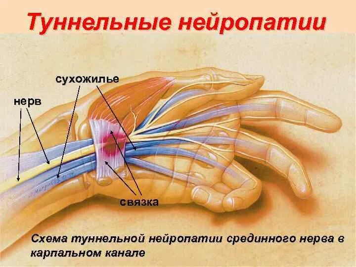 Карпальный туннельный синдром стопы. Туннельный синдром лучевого нерва. Туннельный карпальный синдром руки. Туннельная нейропатия срединного нерва. Синдром карпального канала мкб 10