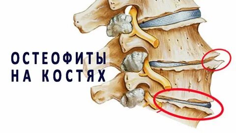 Образование остеофитов