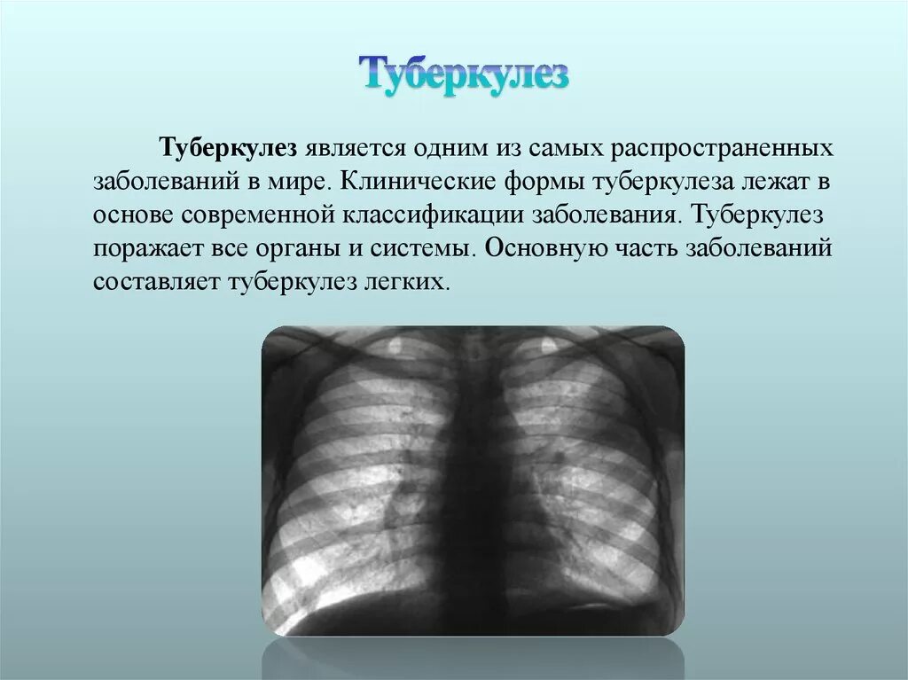 Прогрессирование туберкулеза. Туберкулез легких презентация. Туберкулёз открытой формы. Открытые формы туберкулеза.